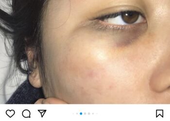 OC서 10대 한인 여성, 인종혐오 희롱에 폭행 피해