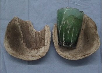 [이런 일도] 여성 방광에 지름 8㎝ 유리컵..어쩌다가?