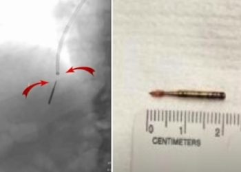 치과진료 중 2㎝ 전동 드릴 흡입…폐 절제 위기?