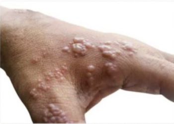 멍키팍스 12개국 감염 “이미 광범위하게 퍼져 있을 것”..치명률 높아