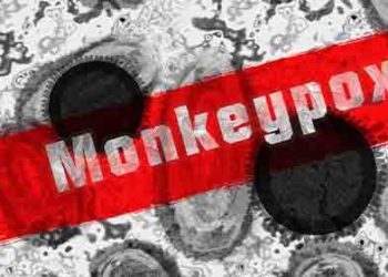 멍키팍스 미국서 9건 확인..WHO “전세계 200여건 발생”