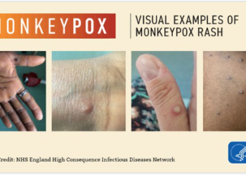 멍키팍스 비상사태 선포하나…WHO, 23일 ‘세계 비상사태’ 여부 결정