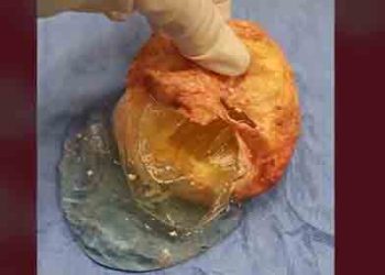 36년 된 가슴 보형물 눌러보니…”끈적한 액체가…”