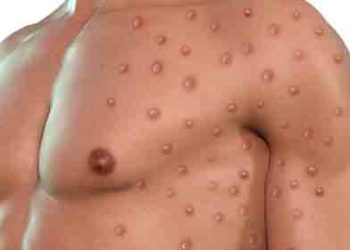 LA 카운티 멍키팍스 두 번째 의심사례 발견