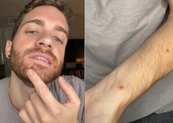 “여드름인 줄”…캘리포니아 배우 ‘멍키팍스’ 경험 영상 공개