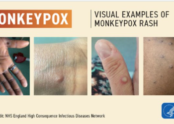 “멍키팍스 억제 실패..미 전역서 유행할 것”