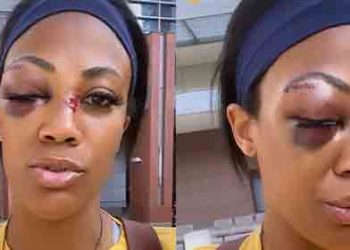 “LA거리 내게도 위험해” 메달리스트, 노숙자에게 쇠파이프 폭행 당해