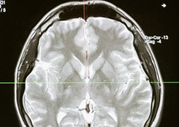 미 병원서 소아뇌감염 환자 236% 증가..코로나와 관련?