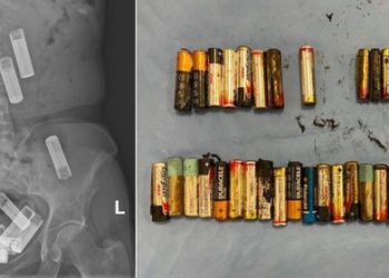 66세 여성 뱃속에 건전지 55개…의사 기겁했다