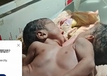 가슴만 공유한 샴쌍둥이 기적적 출생…팔다리 8개