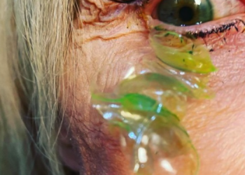 한쪽 눈에서 렌즈 23개 빼낸 여성..렌즈 끼고 수면 실명위험