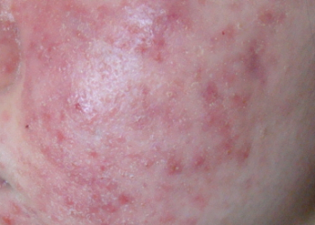 [건강]안면홍조 동반 주사피부염 방치하면 피부암