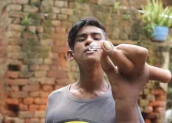 ‘악마의 아이’불리는 소년, 손 ’60㎝’까지 자라