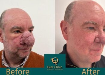 중증 ‘딸기코’ 남성, 성탄절 앞두고 축소 수술 성공