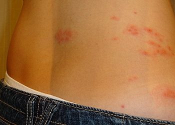 ‘감기몸살인 줄’ 알고보니 대상포진…골든타임 72시간