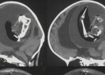 머리 너무 커 열어보니…두개골 안서 ‘쌍둥이’ 발견