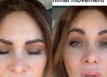 20년 맞던 보톡스 중단했더니…근위축증 앓아