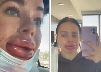 선풍기아줌마된 LA여성 “무료 입술필러 맞지마”