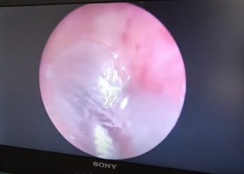 ‘귀에서 이명’ 귓속에 거미 집 있었다