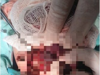 생식기만 2개…항문 없이 태어난 신생아 수술