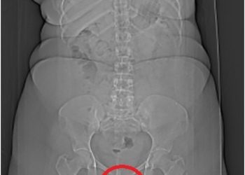 날아든 총알, 여성의 ‘이곳’에 박혀..의학계, 최초사례