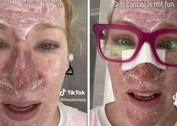 자외선 차단제 없이 태닝한 30년 뒤 얼굴 “경악”