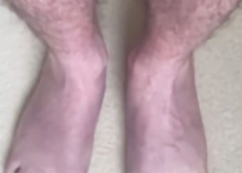 코로나 새 장기 후휴증 보고, ‘푸른 다리 증후군’..서 있으면 다리 푸른빛