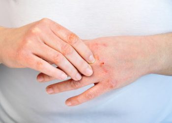 ‘간질간질’ 건선의 계절…’지긋지긋’ 가려움 탈출하려면?