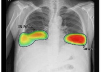 유방암 진단, 의사와 AI 누가 더 정확할까?