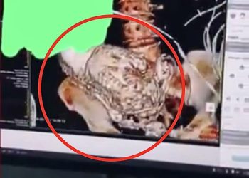 50년간 ‘죽은 태아’ 품고 산 여성…제거수술 후 사망