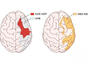“힘 빠지고 발음 어눌” 뇌경색 증상…치료 관건은 ‘이것’