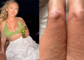 근육통에 발진·발열…여행객 공포 떨게 만든 ‘이 병’