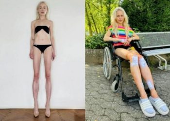 키 169→183㎝…8년 걸쳐 다리 30㎝ 연장한 여성