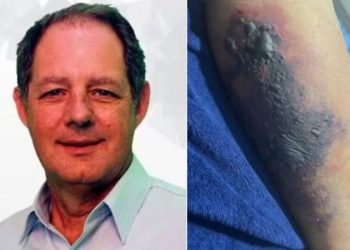 식당에서 독거미 물린 남성 5일 만에 사망