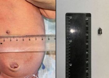 총알 박힌 아이 출산…”사격연습하다 만삭아내 관통”