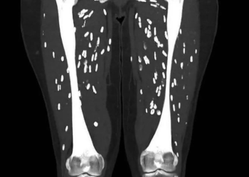 덜 익힌 삼겹살 함부로 먹었다간…온몸에 이것 ‘충격’