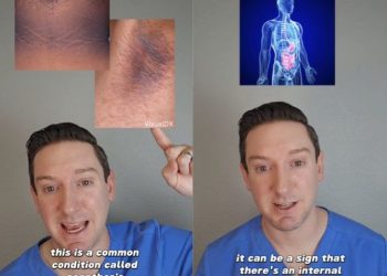 몸에 검은 자국이 생긴다면…’이것’부터 의심해야