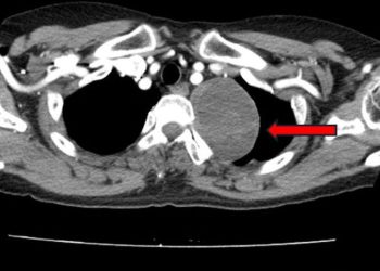 호흡곤란·이물감·쉰목소리…”혹시 가슴뼈·척추사이 암?”