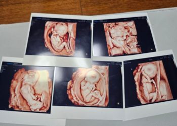 ‘국가적 경사’된 다섯 쌍둥이 출산 … 한국 떠들썩