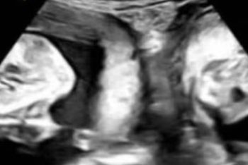 ‘100만분의 1 확률’…자궁 두 개 여성, 쌍둥이 출산