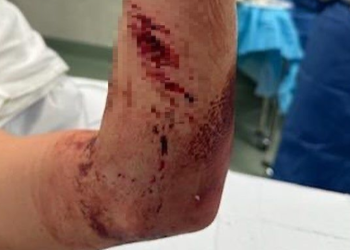 서핑 주니어 미국 대표, 서핑 중 상어에게 물려 팔 잘릴뻔