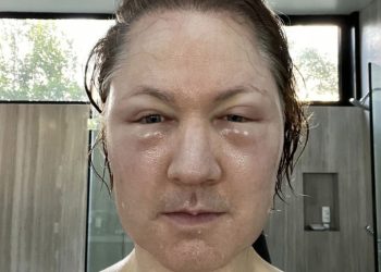 ‘회춘’하려 아들 피 뽑은 억만장자, 얼굴 퉁퉁 부어