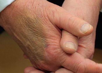 트럼프 손등 멍자국, 건강이상설 … 마크롱과 악수 탓?