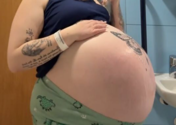 “터지는거 아냐”…심하게 부푼 배 공개 임신부, 원인은?