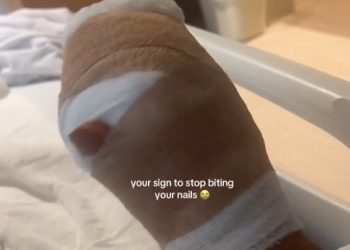 “손톱 물어뜯지 마세요”…수술까지 받은 여성의 경고