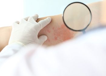 대상포진 백신 맞으면 치매 발병 20% 준다