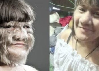 기네스북 오른 털복숭이 소녀…말끔해진 근황