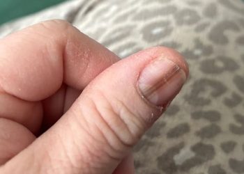 “손톱에 생긴 선이 희귀암?” … 미 여성, 틱톡 영상 덕에 살았다