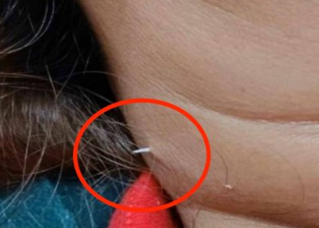 반찬으로 생선 먹었는데…목 뚫고 나온 가시