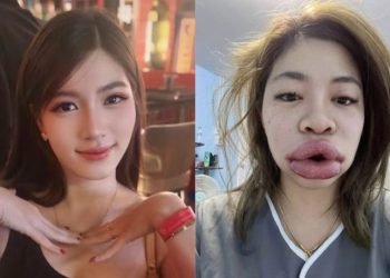 입술 필러의 충격적 부작용 … 입술이 모다피처럼